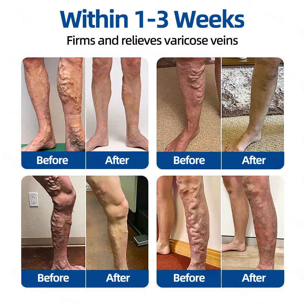 𝑶𝒇𝒇𝒊𝒄𝒊𝒂𝒍 𝑺𝒕𝒐𝒓𝒆🍀|𝐅𝐥𝐨𝐫𝐢𝐬𝐦𝐚® 𝐕𝐞𝐢𝐧𝐓𝐚𝐫𝐠𝐞𝐭 𝐌𝐢𝐜𝐫𝐨𝐧𝐞𝐞𝐝𝐥𝐞 𝐏𝐚𝐭𝐜𝐡⚡Instant Relief, Long-Term Results