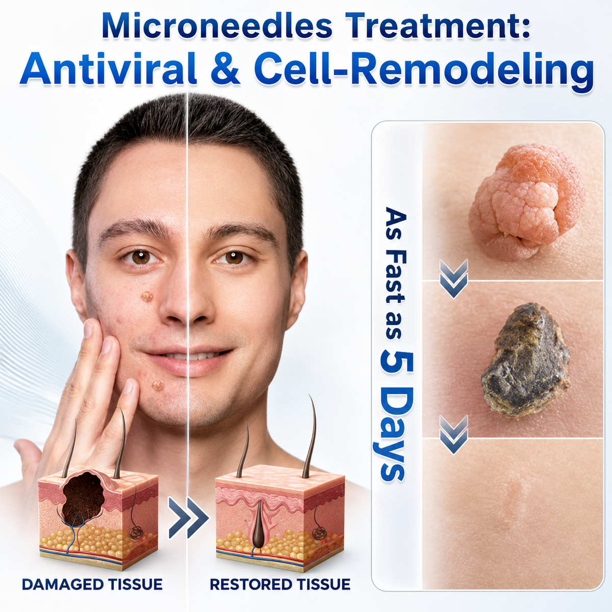 🏅👩🏻‍⚕️ 𝐎𝐟𝐟𝐢𝐜𝐢𝐚𝐥 𝐒𝐭𝐨𝐫𝐞 | 𝑵𝐞𝒌𝐢𝐬𝐬® 🌿 𝐁𝐨𝐭𝐚𝐧𝐢𝐜𝐚𝐥 𝐌𝐢𝐜𝐫𝐨𝐧𝐞𝐞𝐝𝐥𝐞 𝐇𝐲𝐝𝐫𝐨𝐜𝐨𝐥𝐥𝐨𝐢𝐝 𝐏𝐚𝐭𝐜𝐡 (𝐅𝐨𝐫 𝐒𝐤𝐢𝐧 𝐓𝐚𝐠𝐬, 𝐒𝐦𝐚𝐥𝐥 𝐒𝐤𝐢𝐧 𝐆𝐫𝐨𝐰𝐭𝐡𝐬, 𝐖𝐚𝐫𝐭𝐬, 𝐌𝐨𝐥𝐞𝐬, 𝐀𝐠𝐞 𝐒𝐩𝐨𝐭𝐬 & 𝐏𝐢𝐠𝐦𝐞𝐧𝐭𝐚𝐭𝐢𝐨𝐧 𝐂𝐨𝐧𝐜𝐞𝐫𝐧𝐬)